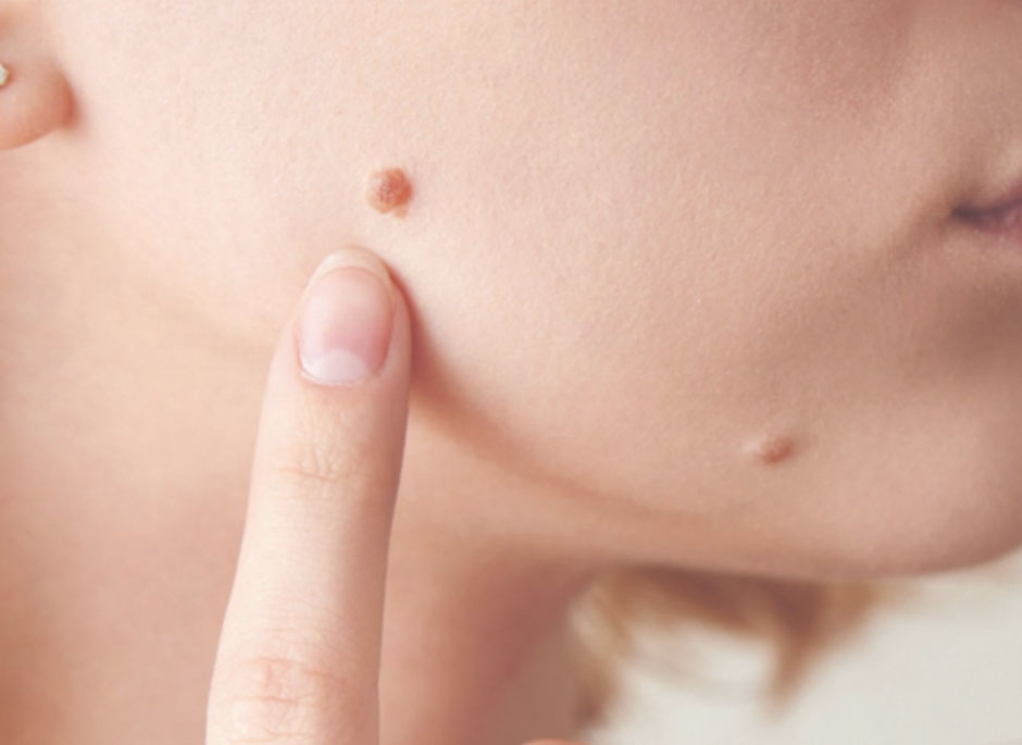 Best Oils and Remedies for Mole Removal Without Scars