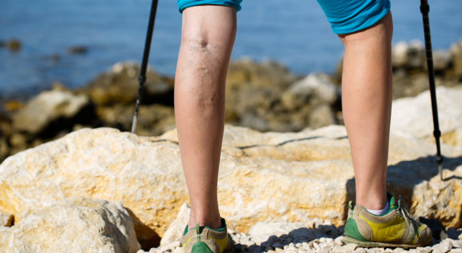 Understanding Vein Issues in Men: What You Need to Know